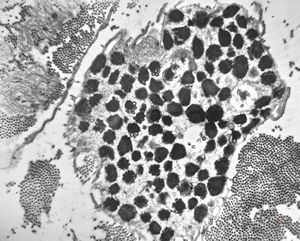 F,23y. | mast cell - n. suralis, demyelinating neuropathy